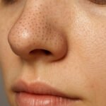 Why Do Blackheads Occur? Root Cause Revealed!